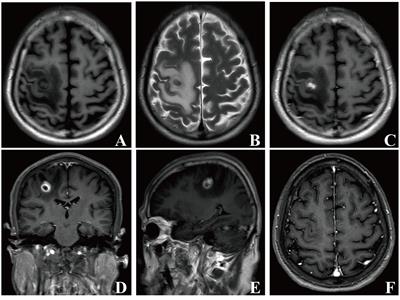 Case report: Two case reports of cryptogenic brain abscess caused by Fusobacterium nucleatum and literature review